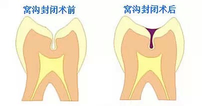 窝沟封闭前后