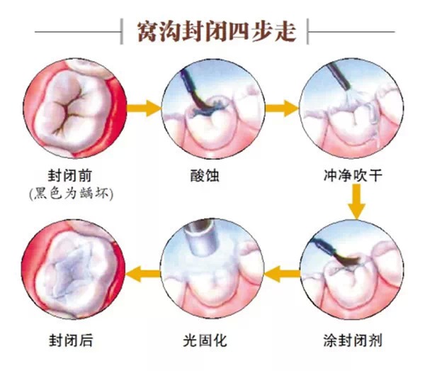 窝沟封闭四步走