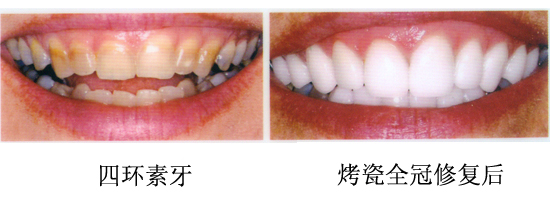 是什么引起的四环素牙