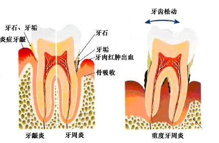 如何辨别自己是患了牙龈炎还是牙周炎