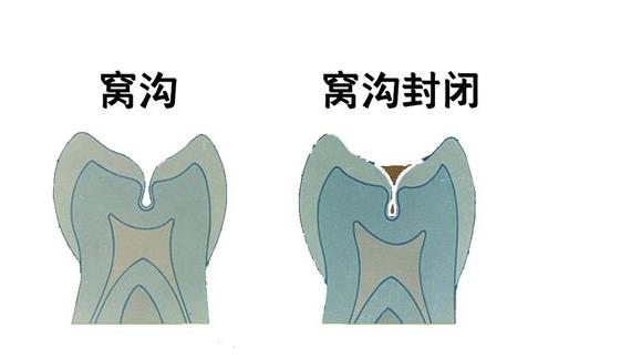 窝沟封闭有哪些材料