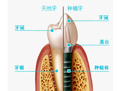 种植牙的材料