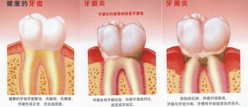 牙龈红肿是牙龈炎还是牙周炎？ 