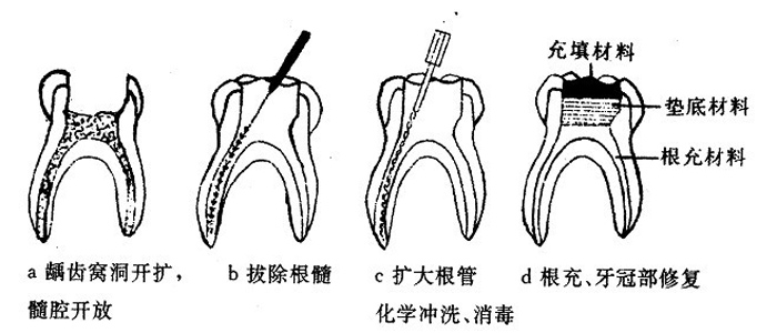 根管治疗后为什么还要做牙冠？