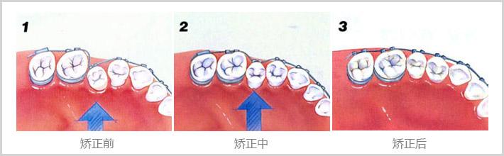 小孩几岁做口腔正畸好