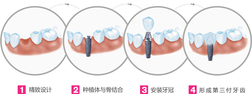 拔除残根后多久才能种牙