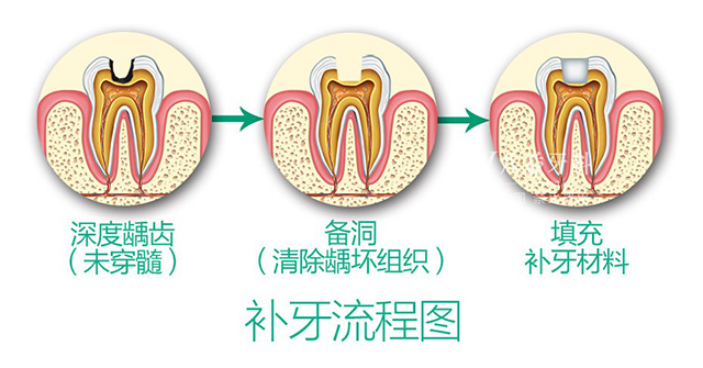 补牙流程图