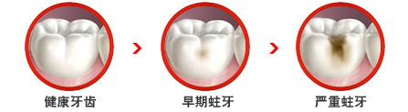 龋齿产生的几大条件都有哪些