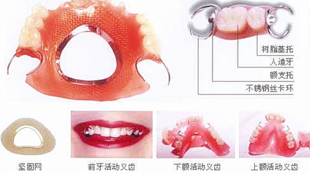 活动假牙