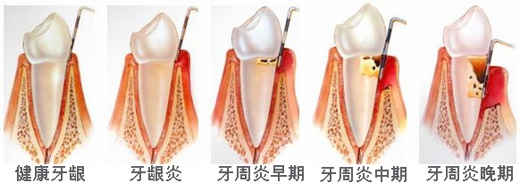 牙周病过程