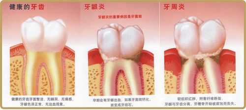 患上牙周炎该怎么治疗呢
