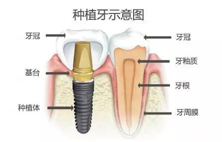 种植牙选什么种植系统比较好