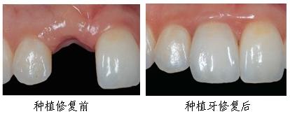 冬天种牙效果好不好