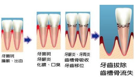牙周病都有哪些危害？