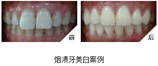 如何有效去除牙齿上的烟渍