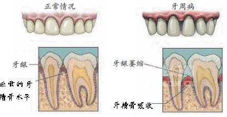 牙周病治疗的费用是多少？