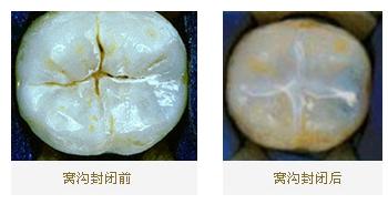 预防蛀牙做窝沟封闭真的有效吗