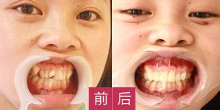 牙齿轻微不齐需要矫正吗