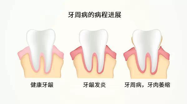 患有牙周病还可以洗牙吗？