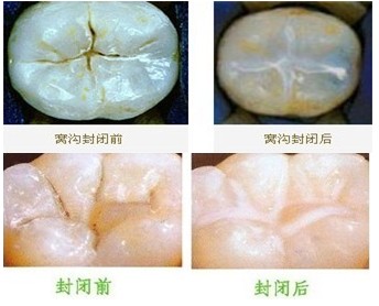 如何保障儿童窝沟封闭的效果？