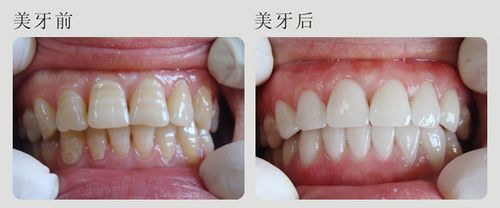 四环素牙怎么美白效果好