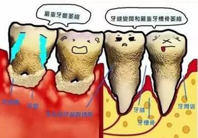 牙周病的主要表现