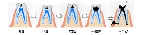 患龋齿有哪些危害