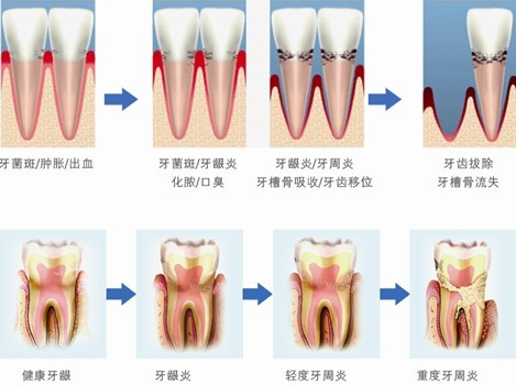 哪些牙周病可以通过洗牙来预防