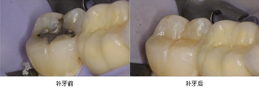蛀牙疼痛时能补牙吗