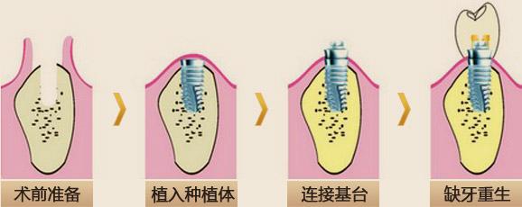 种牙后多久能吃东西