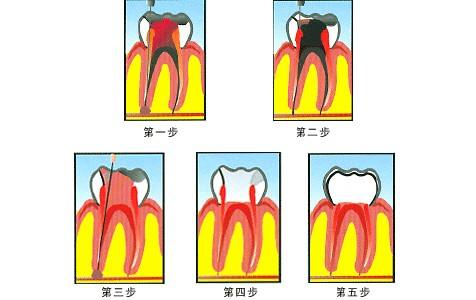 西安牙髓炎如何治疗