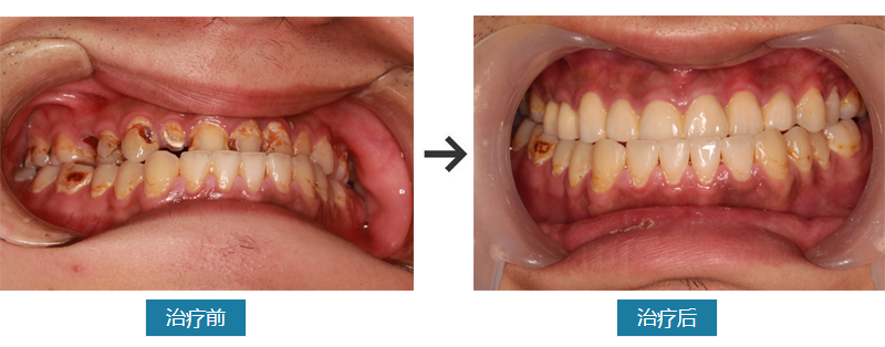 根管治疗案例对比