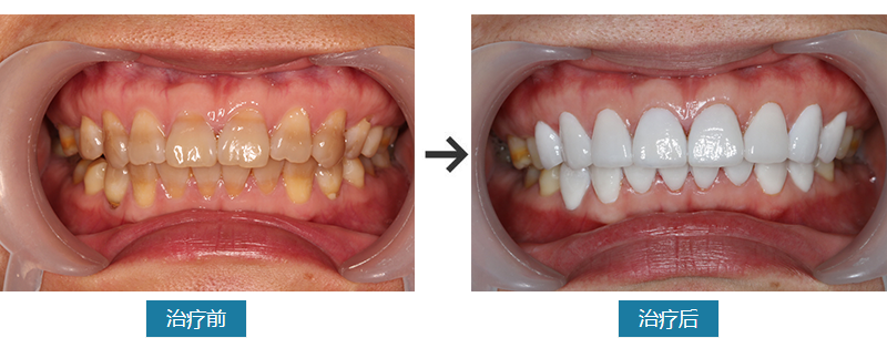 瓷贴面修复对比