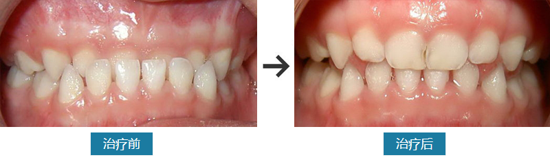 乳牙地包天治疗对比
