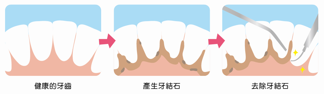 洗牙的与刷牙的区别