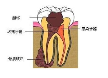 西安治疗急性牙髓炎的方法有哪些
