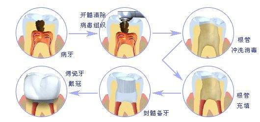 西安治疗牙髓炎要多少钱