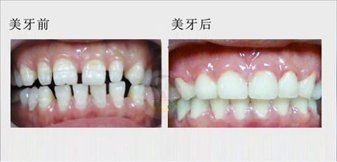 牙齿稀疏矫正对比