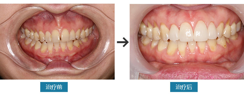 门牙缝隙大瓷贴面