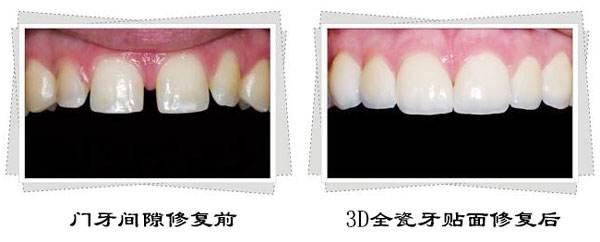 全瓷牙修复效果好不好