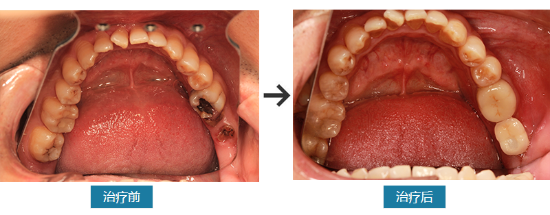 种植牙案例对比