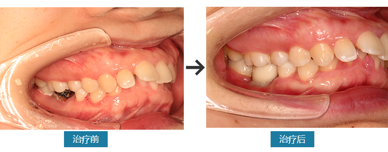 仅半小时---种植牙让牙齿重生