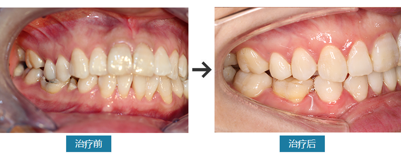 矫正牙齿不容易，矫正完成更珍惜