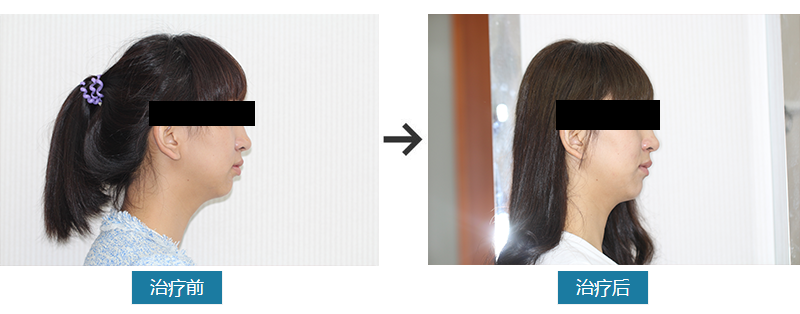 矫正牙齿不容易，矫正完成更珍惜