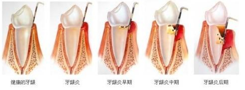 虫牙变黑是怎么回事