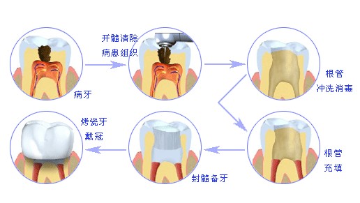 根管治疗的过程