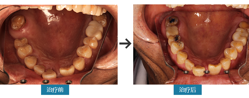 多年缺牙种植获新生