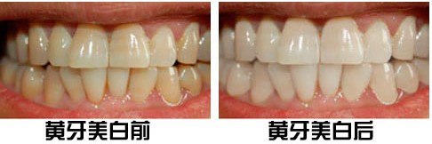 牙齿黄怎么办