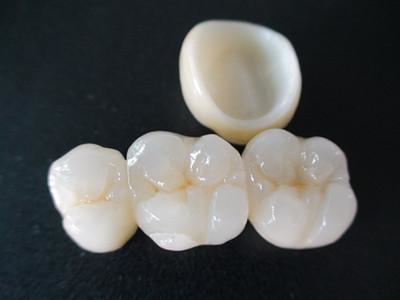做烤瓷牙会脱落吗