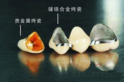全口烤瓷牙价格